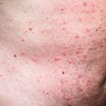 Hypnosis MP3 to Treat Eczema