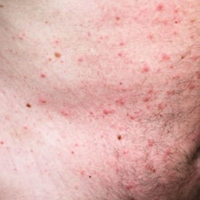Hypnosis MP3 to Treat Eczema