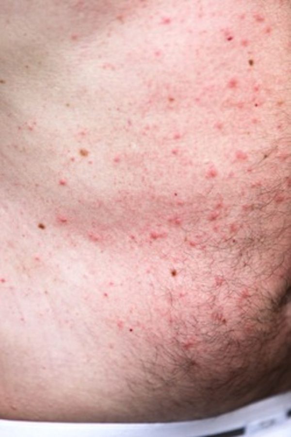 Hypnosis MP3 to Treat Eczema