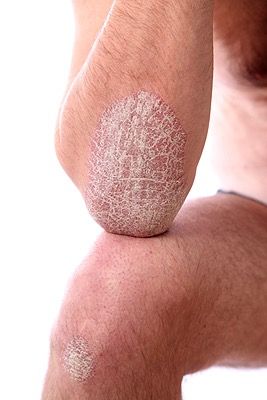 NYC_Skin_Condition_Hypnosis_New_York NYC Hypnotherapy to Overcome Skin Disorders Hypnosis New York